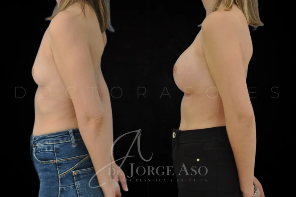 Aumento de pecho antes y después, prótesis redondas, 335 cc, perfil alto, vista lateral