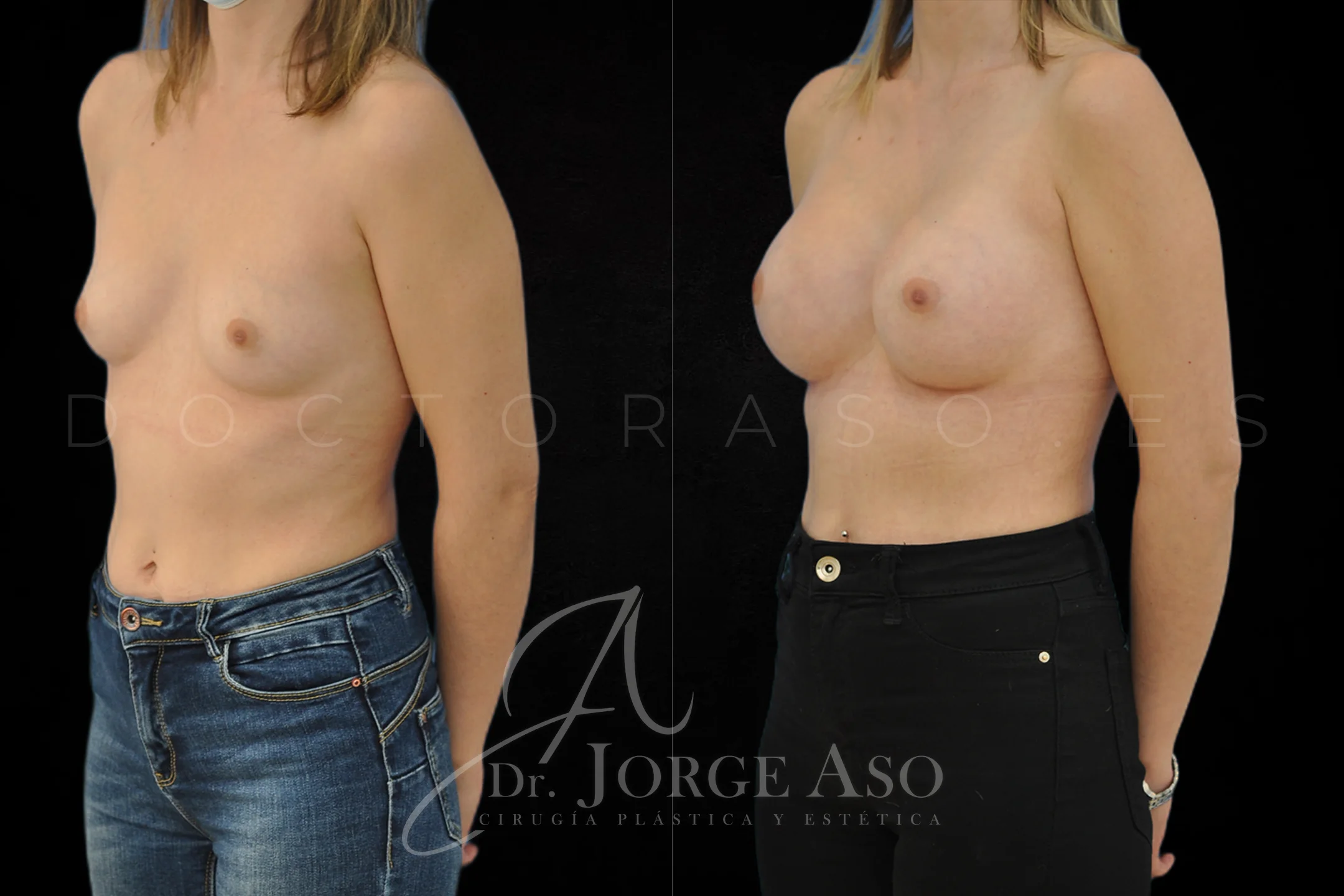 Aumento de pecho con protesis Redondas de 335 cc perfil Alto vista oblicua