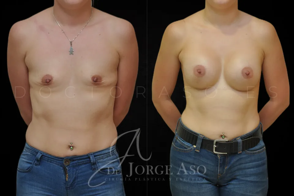 Aumento de pecho antes y después, prótesis redondas, 340 cc, perfil alto, vista frontal