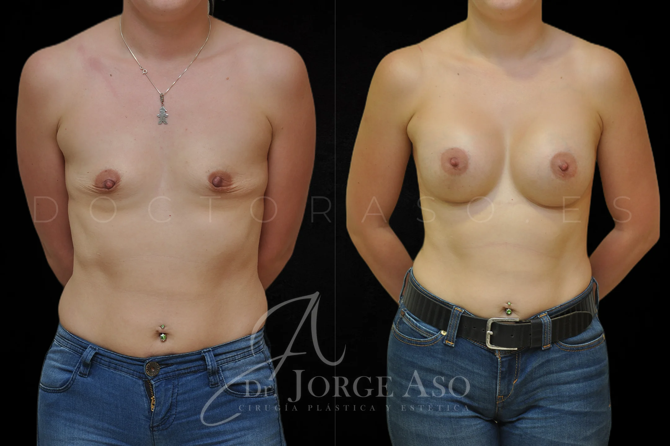 Aumento de pecho con protesis Redondas de 340 cc perfil Alto vista frontal