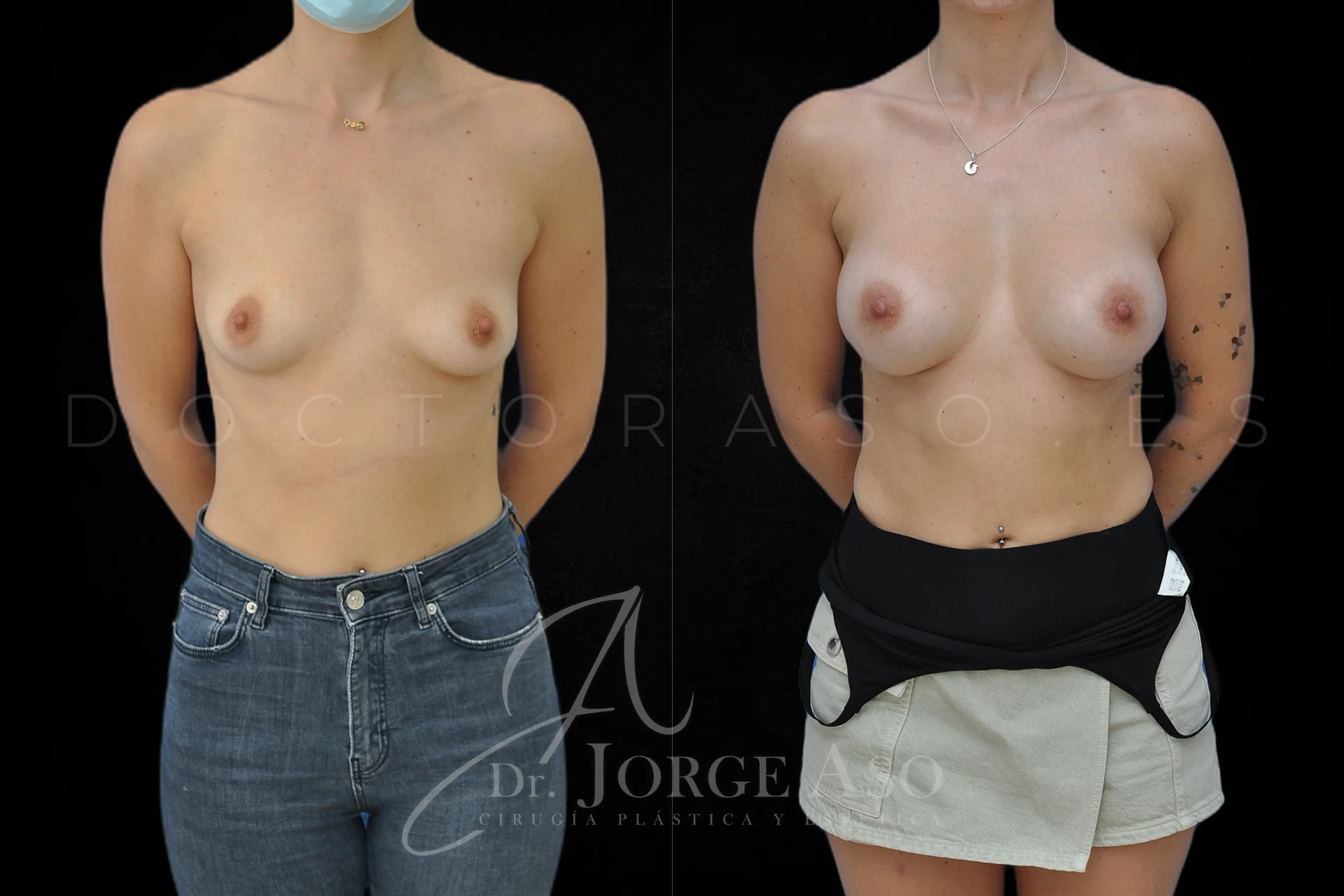 Aumento de pecho con protesis Redondas de 360 cc perfil Alto vista frontal