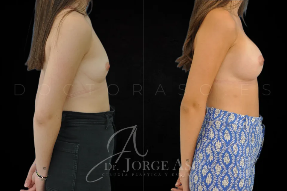Aumento de pecho antes y después, prótesis redondas, 360 cc, perfil alto, vista lateral