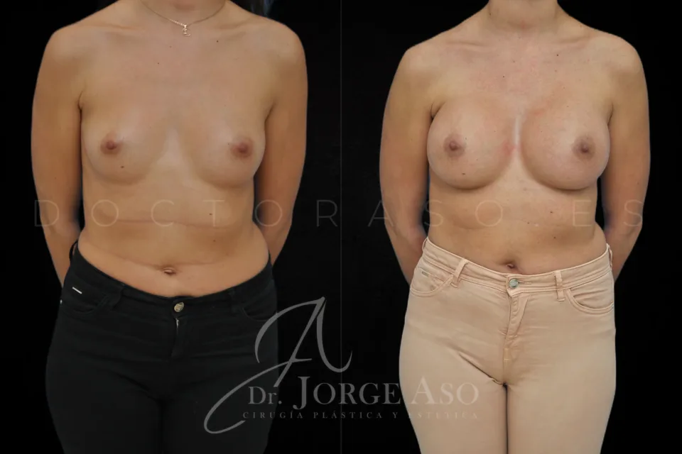 Aumento de pecho antes y después, prótesis redondas, 360 cc, perfil alto, vista frontal