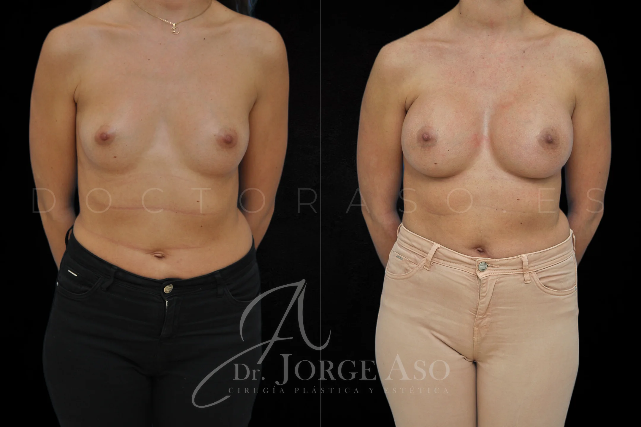 Aumento de pecho con protesis Redondas de 360 cc perfil Alto vista frontal