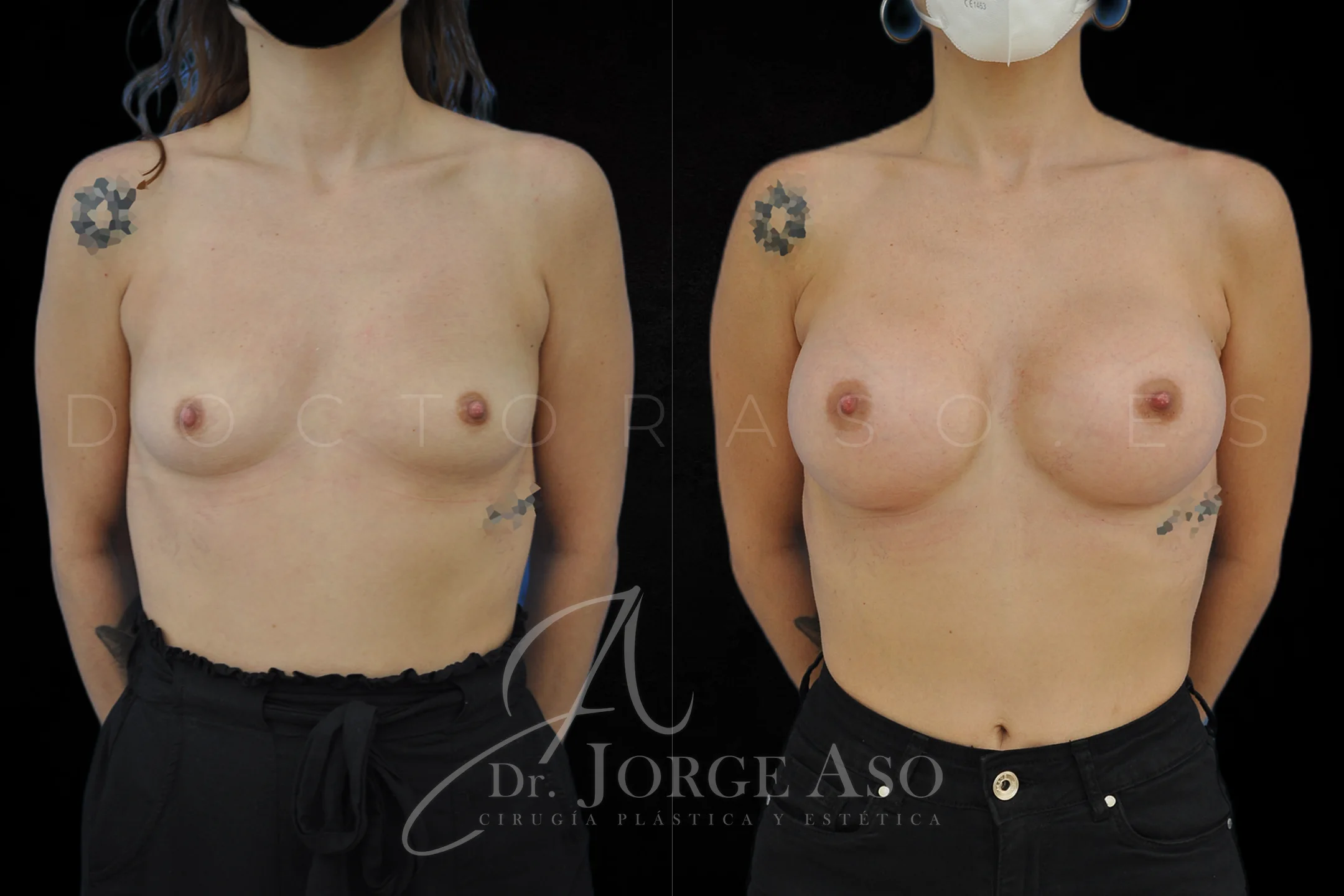 Aumento de pecho con protesis Redondas de 360 cc perfil Alto vista frontal