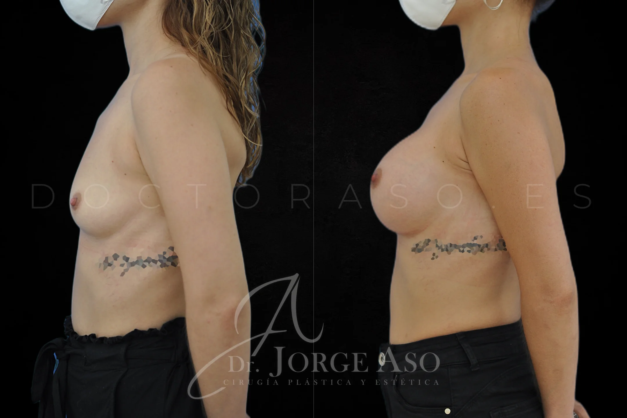 Aumento de pecho con protesis Redondas de 360 cc perfil Alto vista lateral