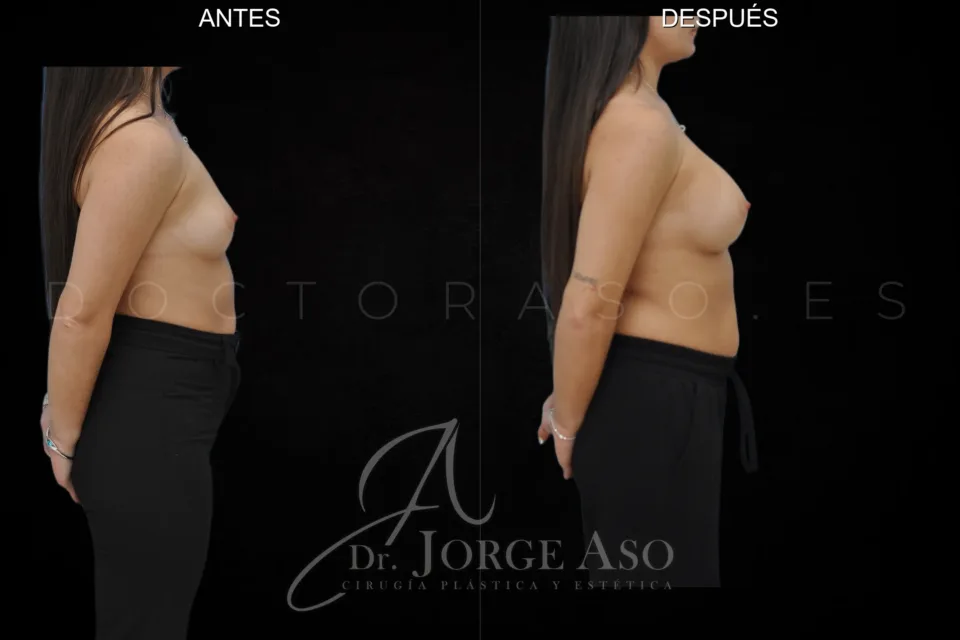Aumento de pecho antes y después, prótesis redondas, 360 cc, perfil alto, vista lateral