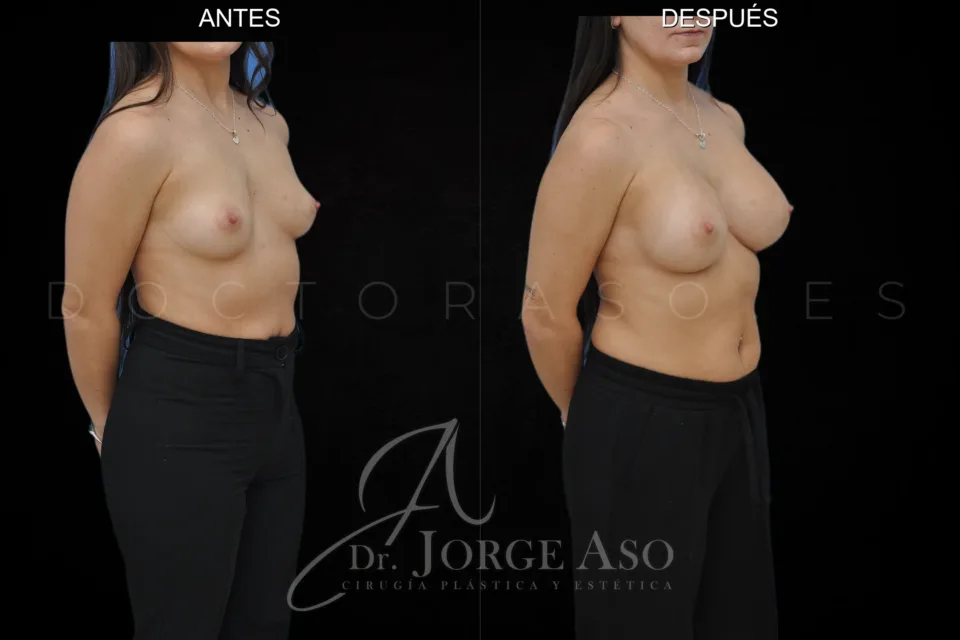 Aumento de pecho antes y después, prótesis redondas, 360 cc, perfil alto, vista oblicua