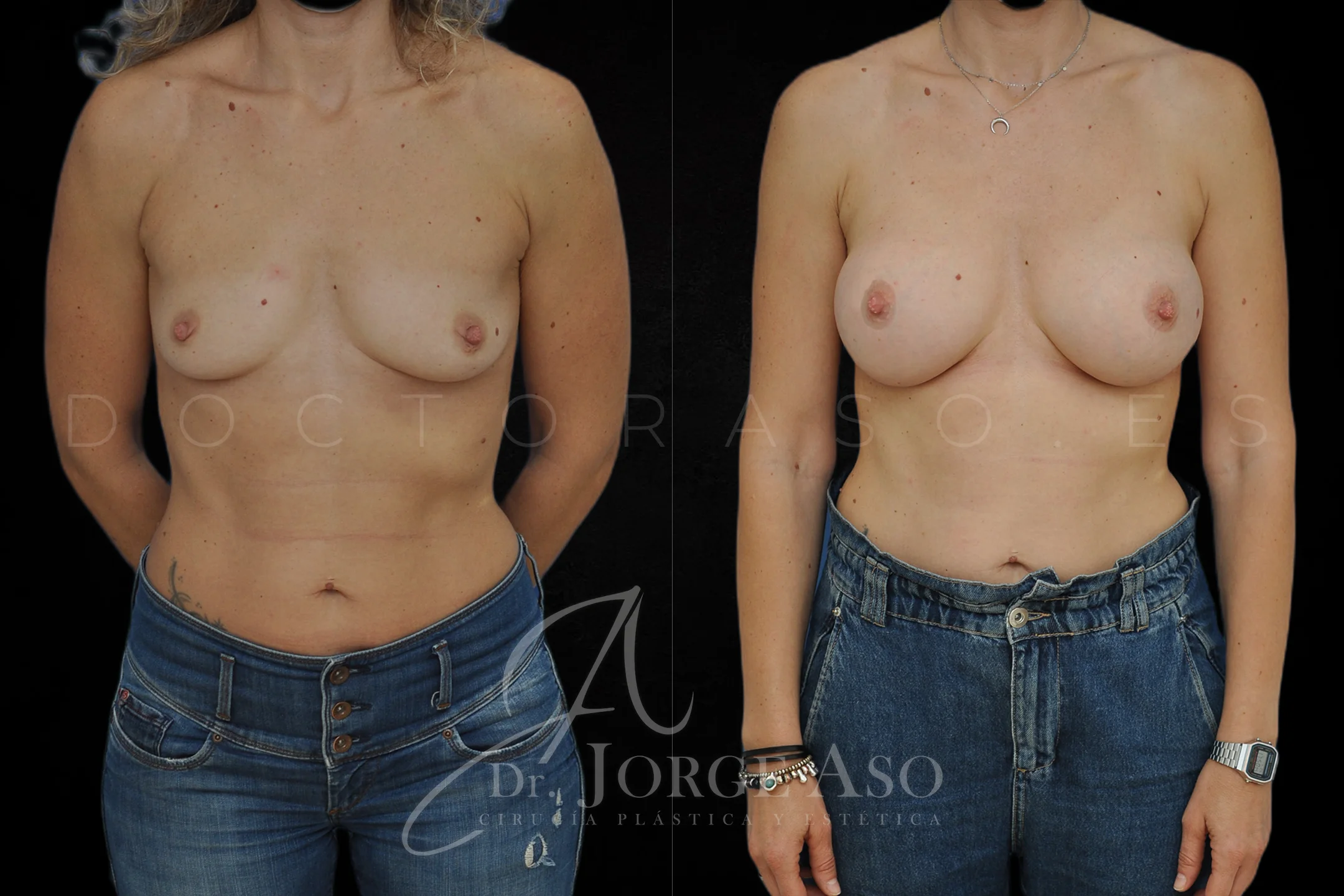 Aumento de pecho con protesis Redondas de 360 cc perfil Extra alto vista frontal