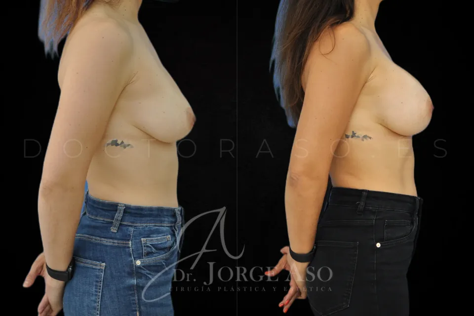 Aumento de pecho antes y después, prótesis redondas, 365 cc, perfil alto, vista lateral