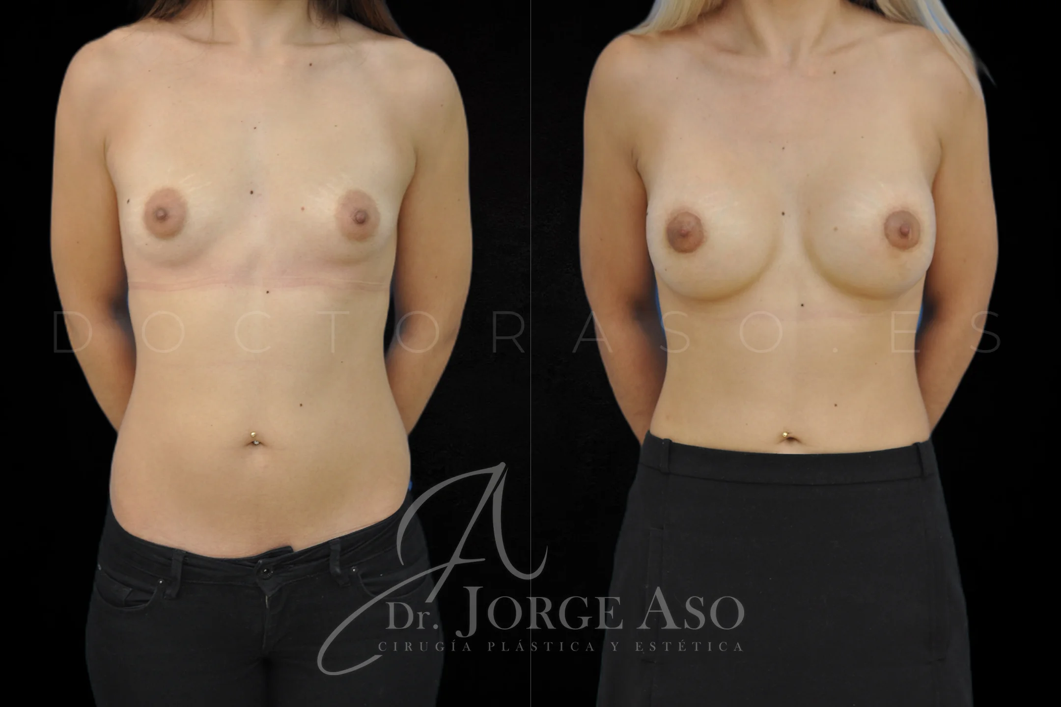 Aumento de pecho con protesis Redondas de 400 cc perfil Alto vista frontal