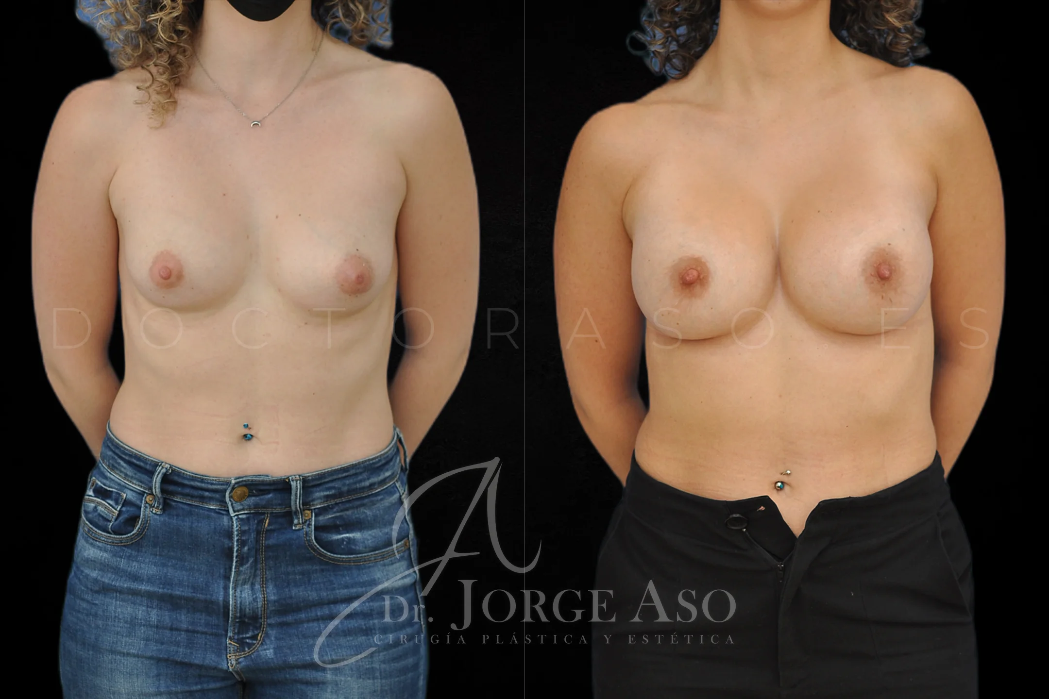 Aumento de pecho con protesis Redondas de 400 cc perfil Alto vista frontal
