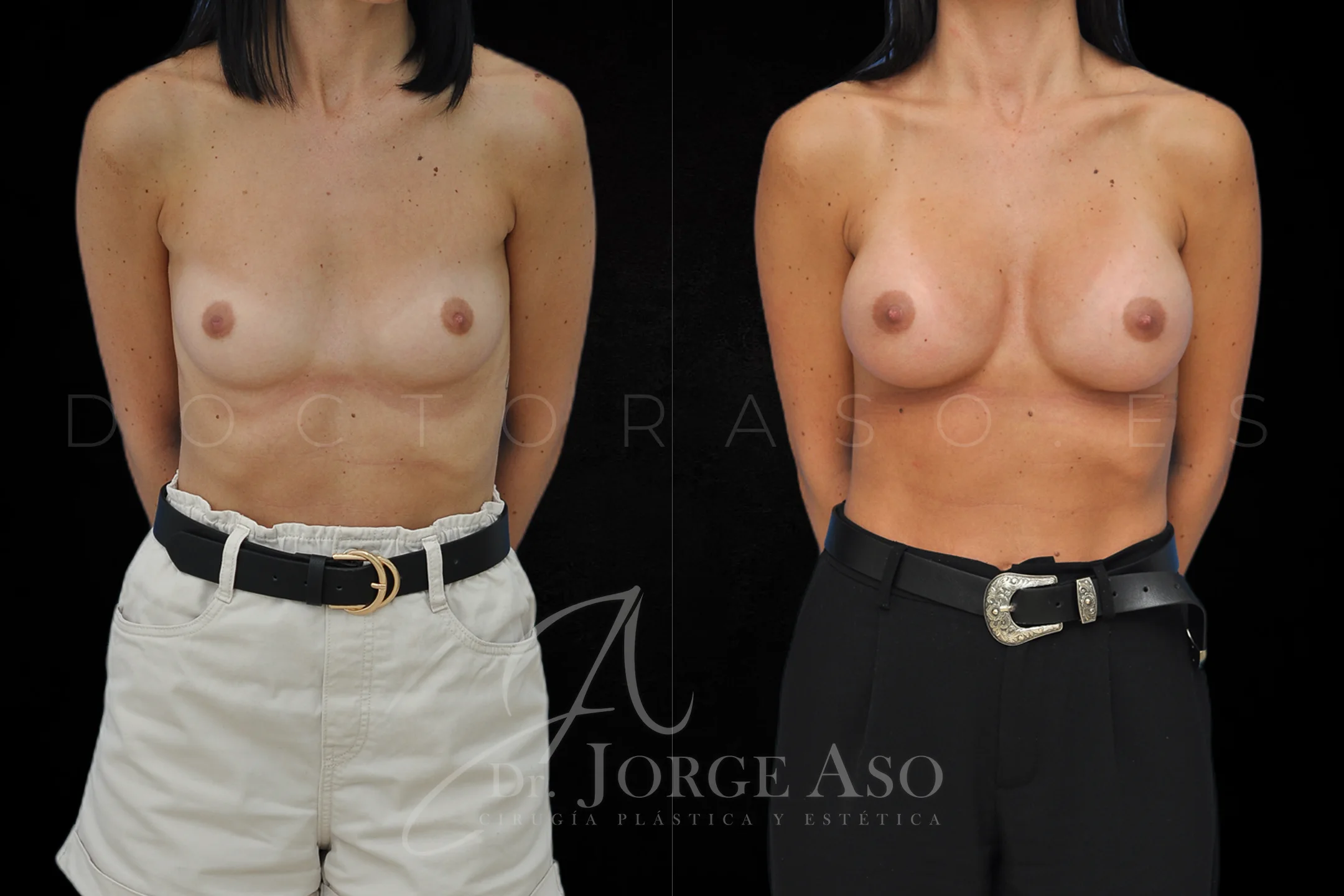 Aumento de pecho con protesis Redondas de 400 cc perfil Alto vista frontal