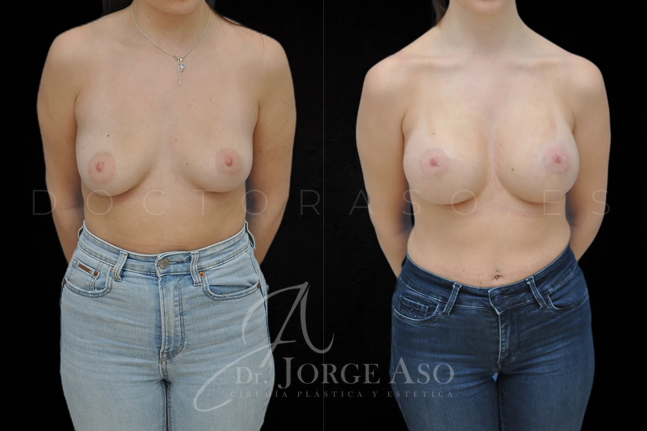 Aumento de pecho con protesis Redondas de 430 cc perfil Extra alto vista frontal