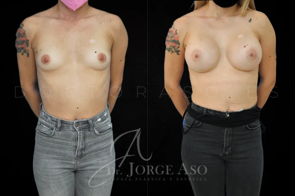 Aumento de pecho antes y después, prótesis redondas, 450 cc, perfil alto, vista frontal