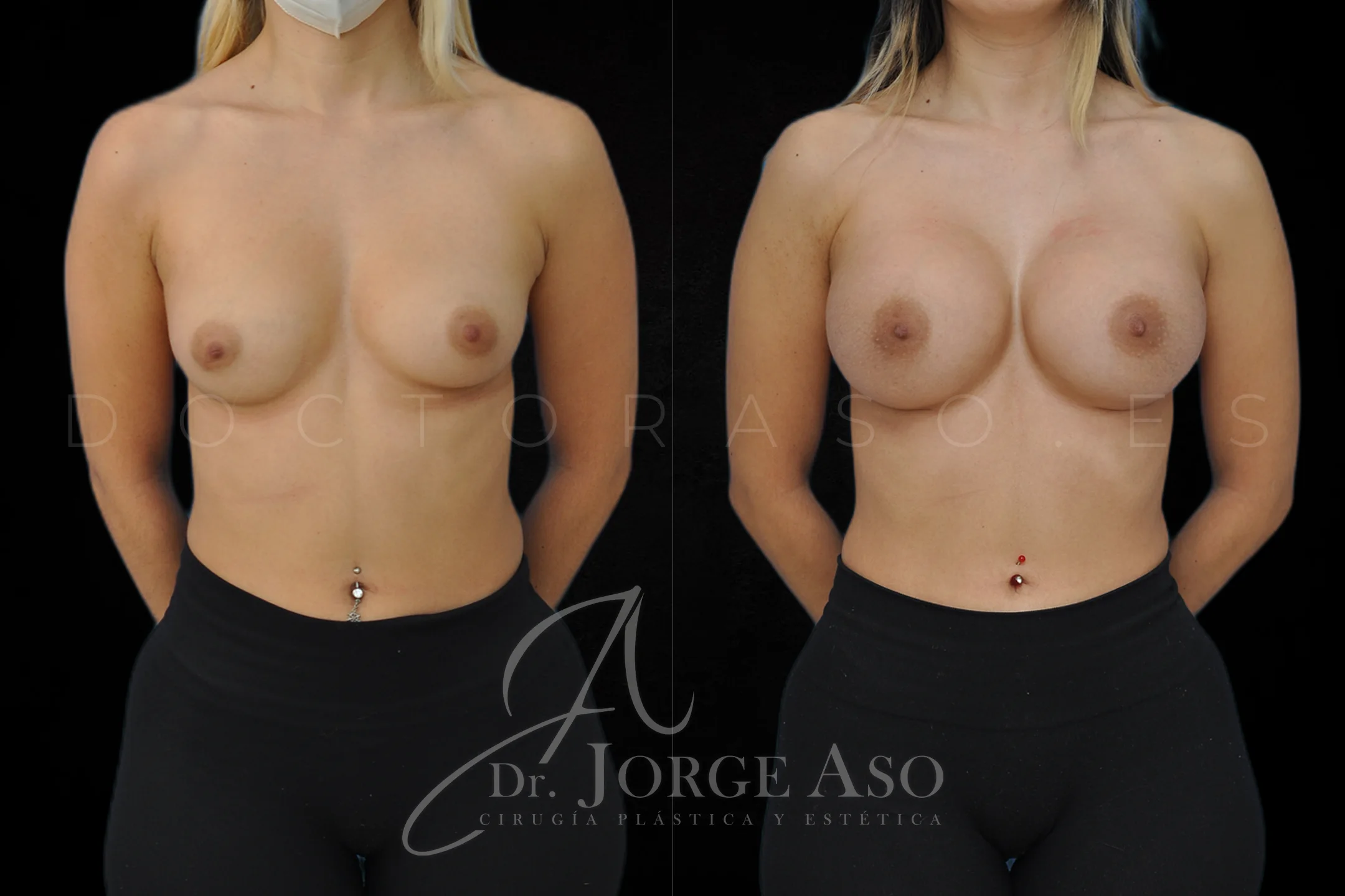 Aumento de pecho con protesis Redondas de 450 cc perfil Alto vista frontal