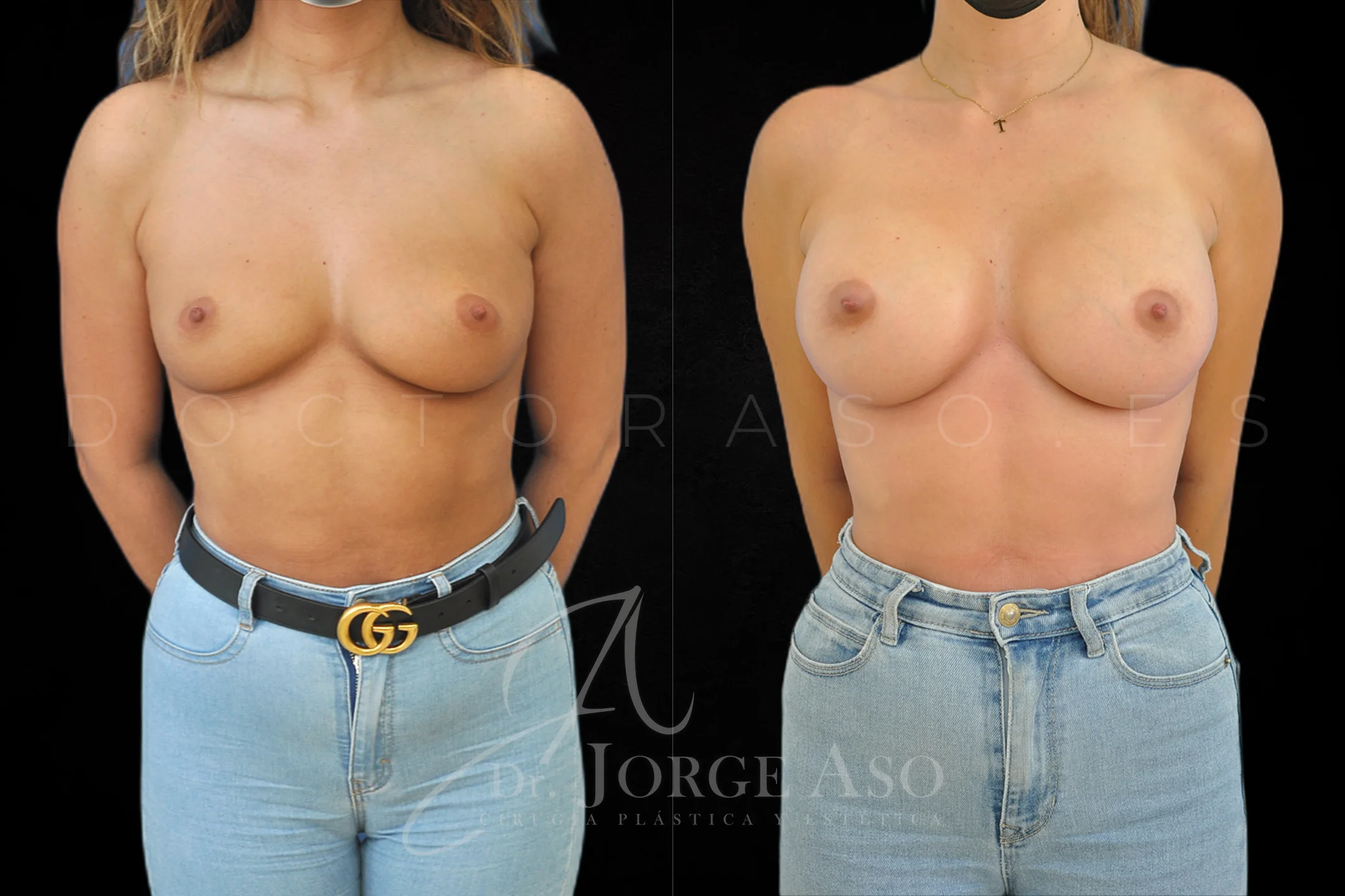 Aumento de pecho con protesis Redondas de 450 cc perfil Alto vista frontal