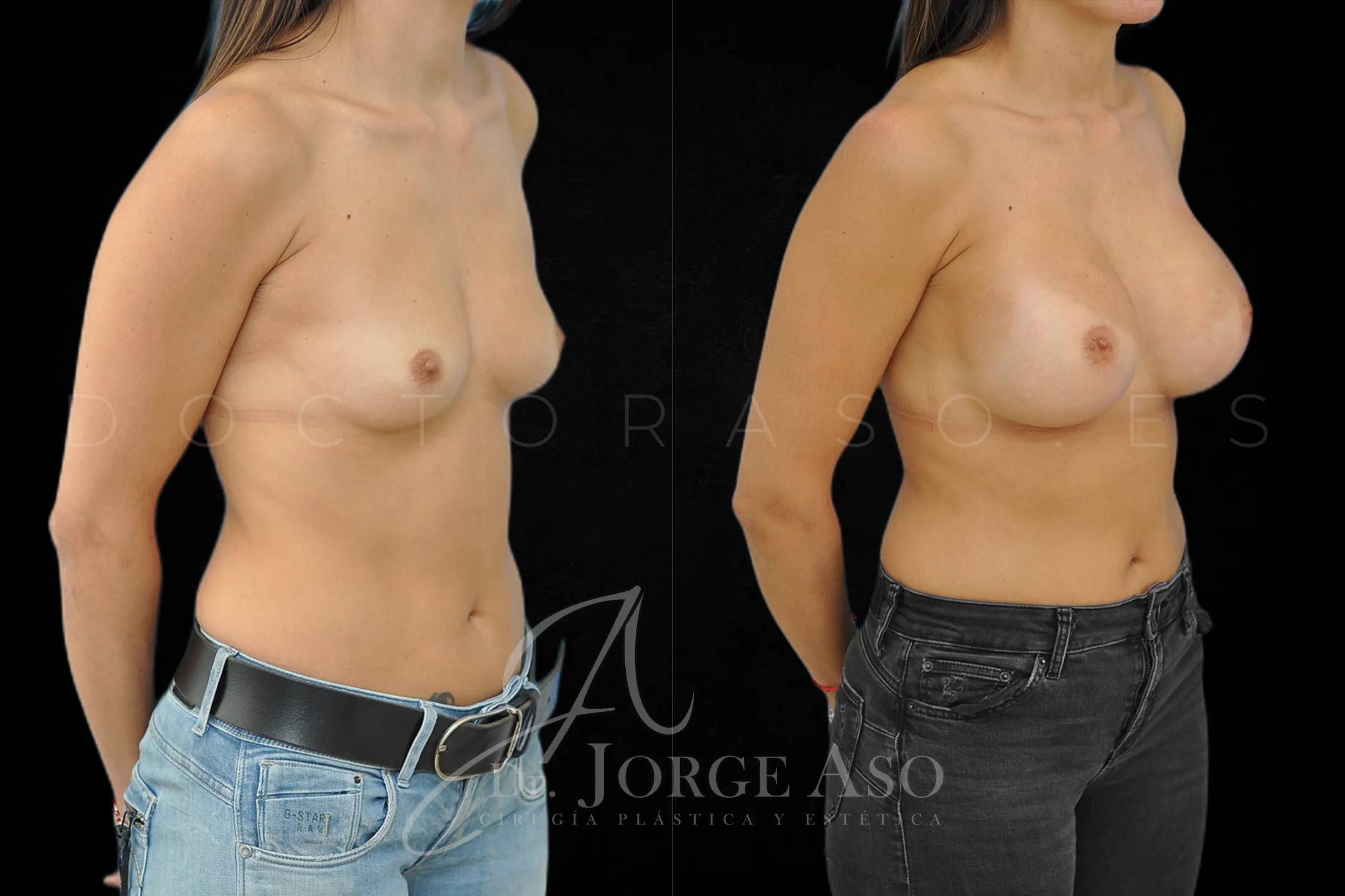 Aumento de pecho con protesis Redondas de 450 cc perfil Alto vista oblicua