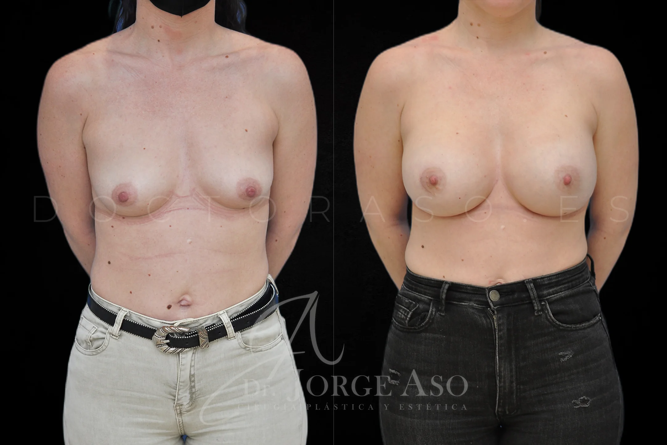 Aumento de pecho con protesis Redondas de 505 cc perfil Alto vista frontal