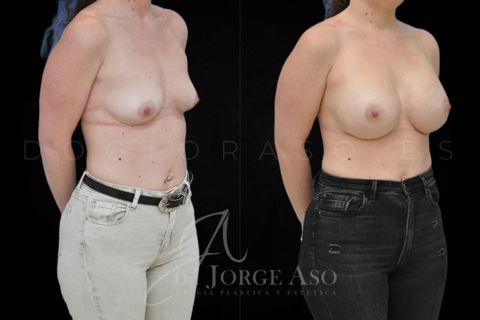 Aumento de pecho antes y después, prótesis redondas, 505 cc, perfil alto, vista oblicua