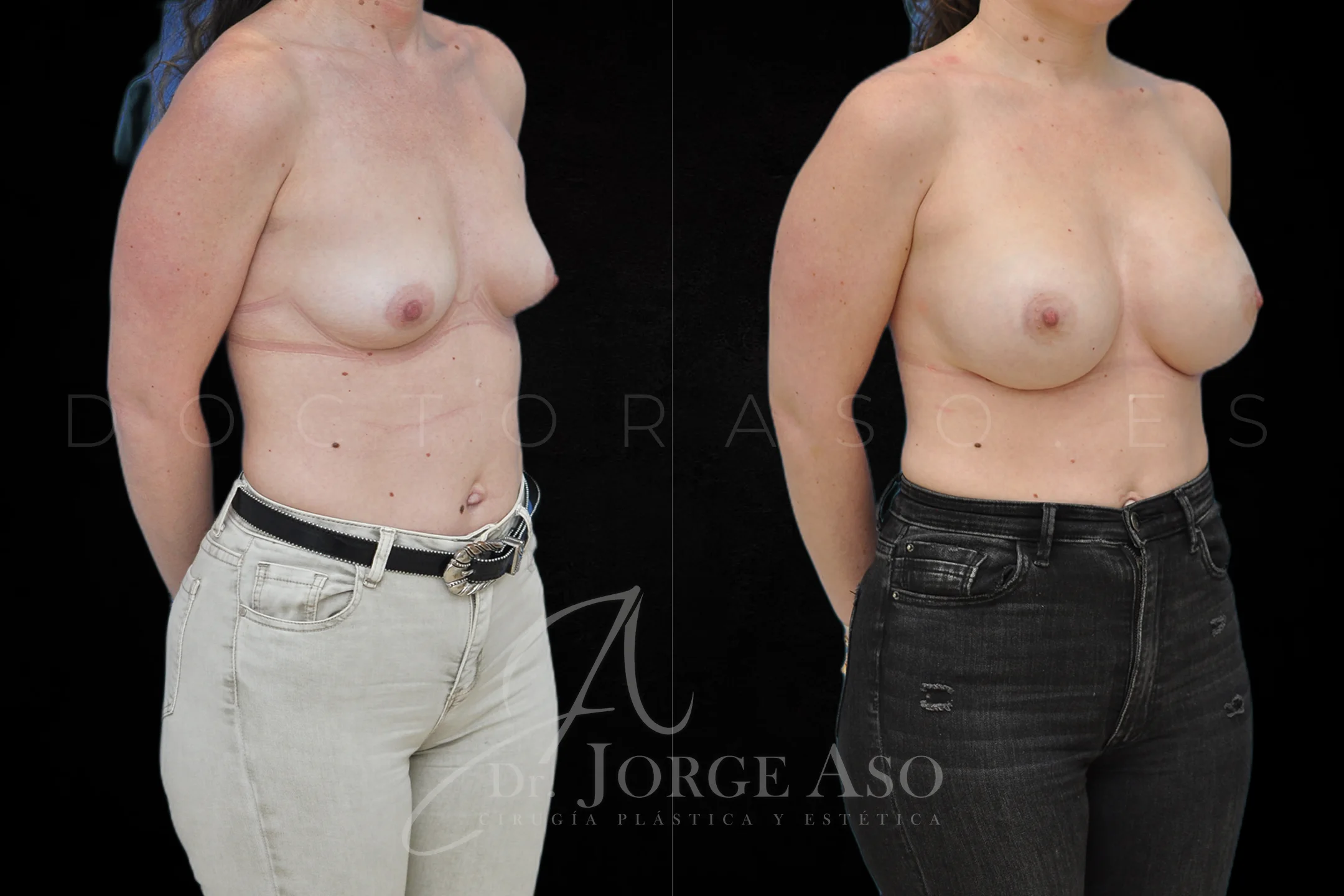 Aumento de pecho con protesis Redondas de 505 cc perfil Alto vista oblicua