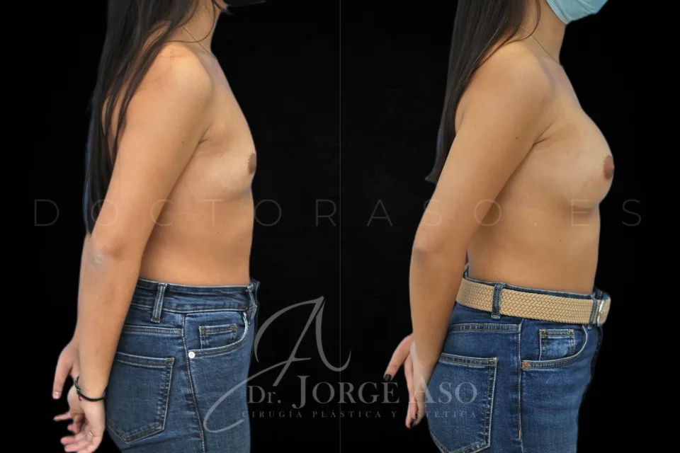 Aumento de pecho antes y después, prótesis anatómicas, 255 cc, perfil moderado, vista lateral