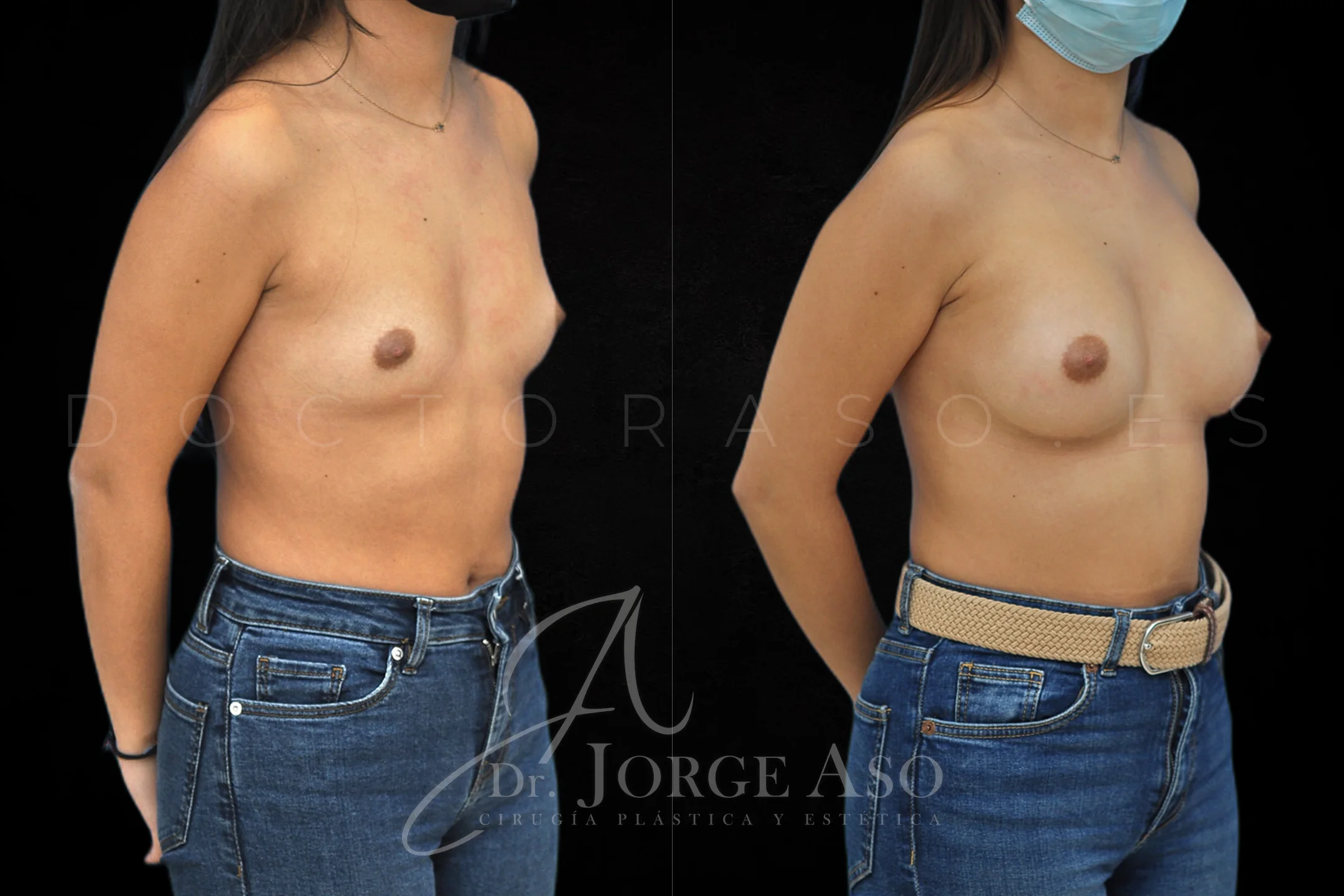 Aumento de pecho con protesis Anatómicas de 255 cc perfil Moderado vista oblicua