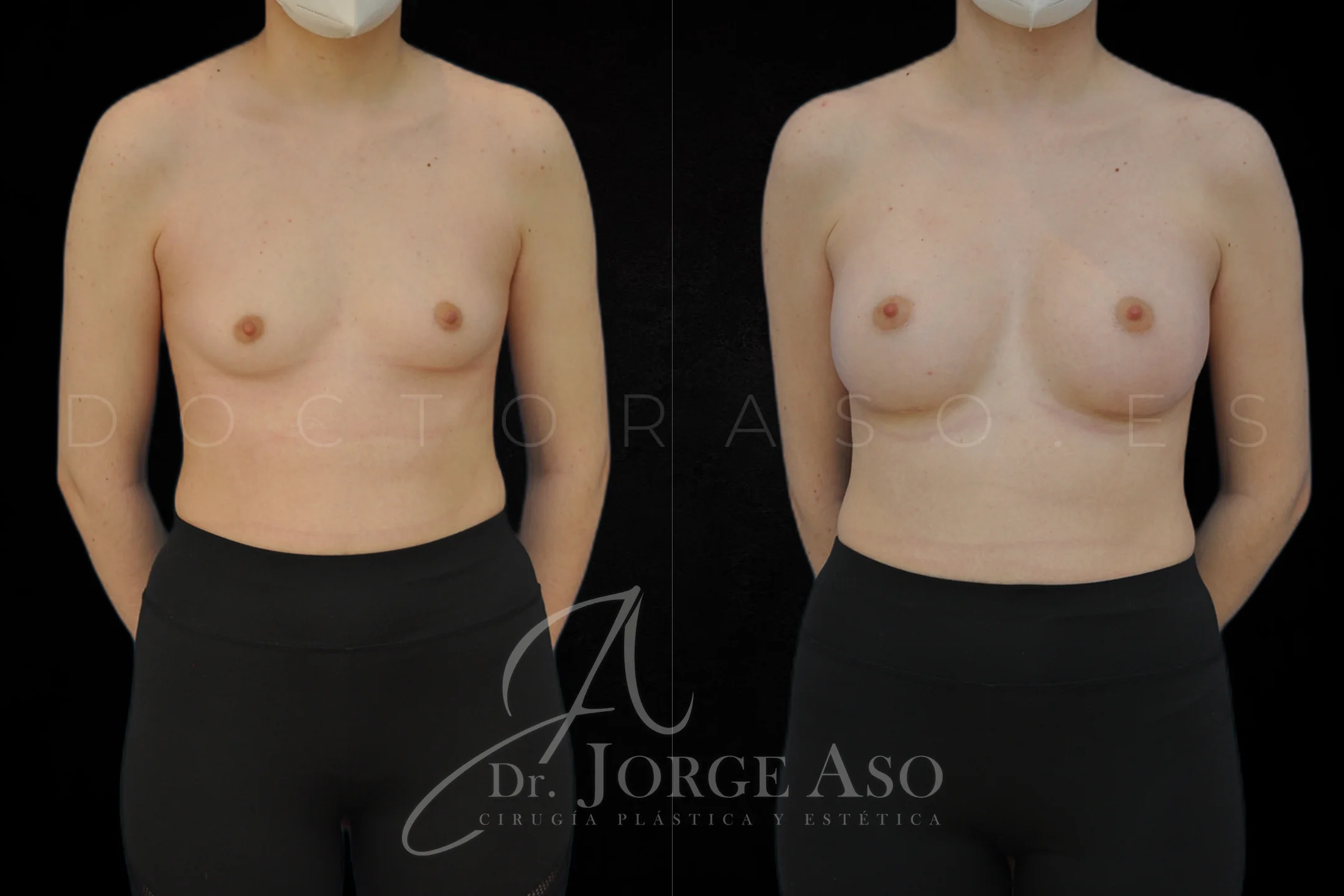 Aumento de pecho con protesis Anatómicas de 395 cc perfil Alto vista frontal