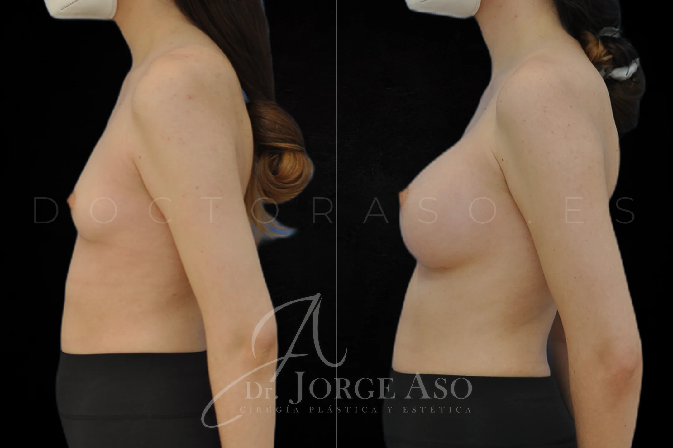 Aumento de pecho con protesis Anatómicas de 395 cc perfil Alto vista lateral