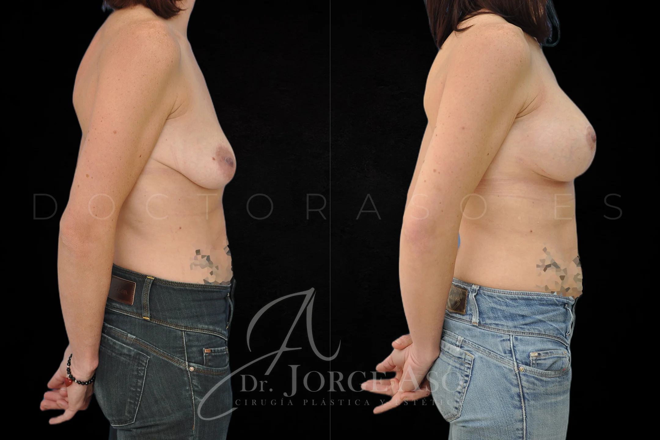 Mastopexia antes y despues con protesis Anatómicas de 395 cc vista lateral