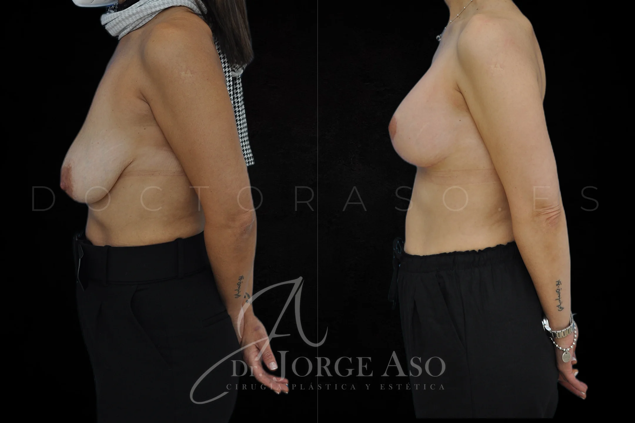 Mastopexia antes y despues con protesis Redondas de 300 cc vista lateral