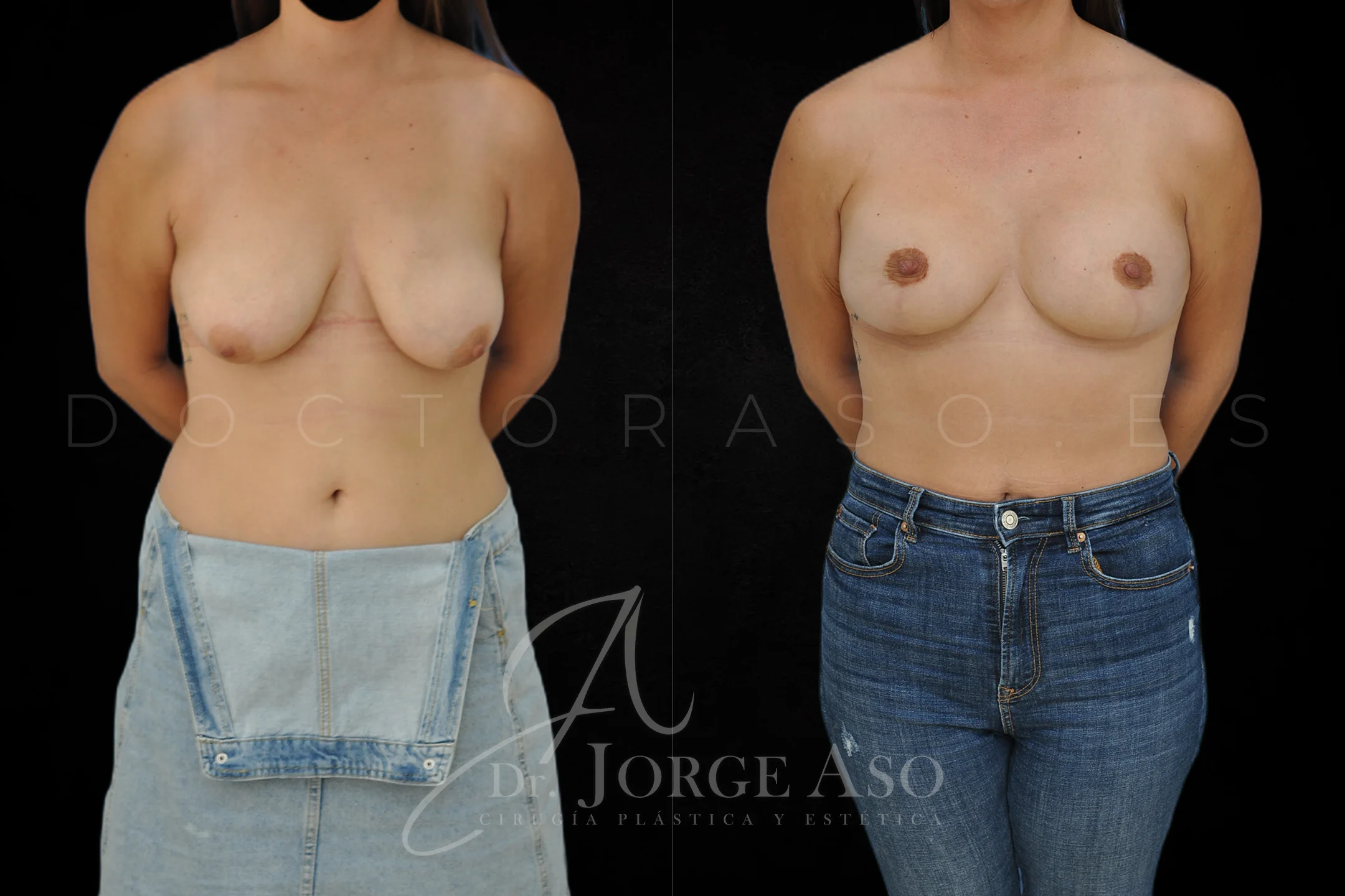 Mastopexia antes y despues con protesis Redondas de 320 cc vista frontal