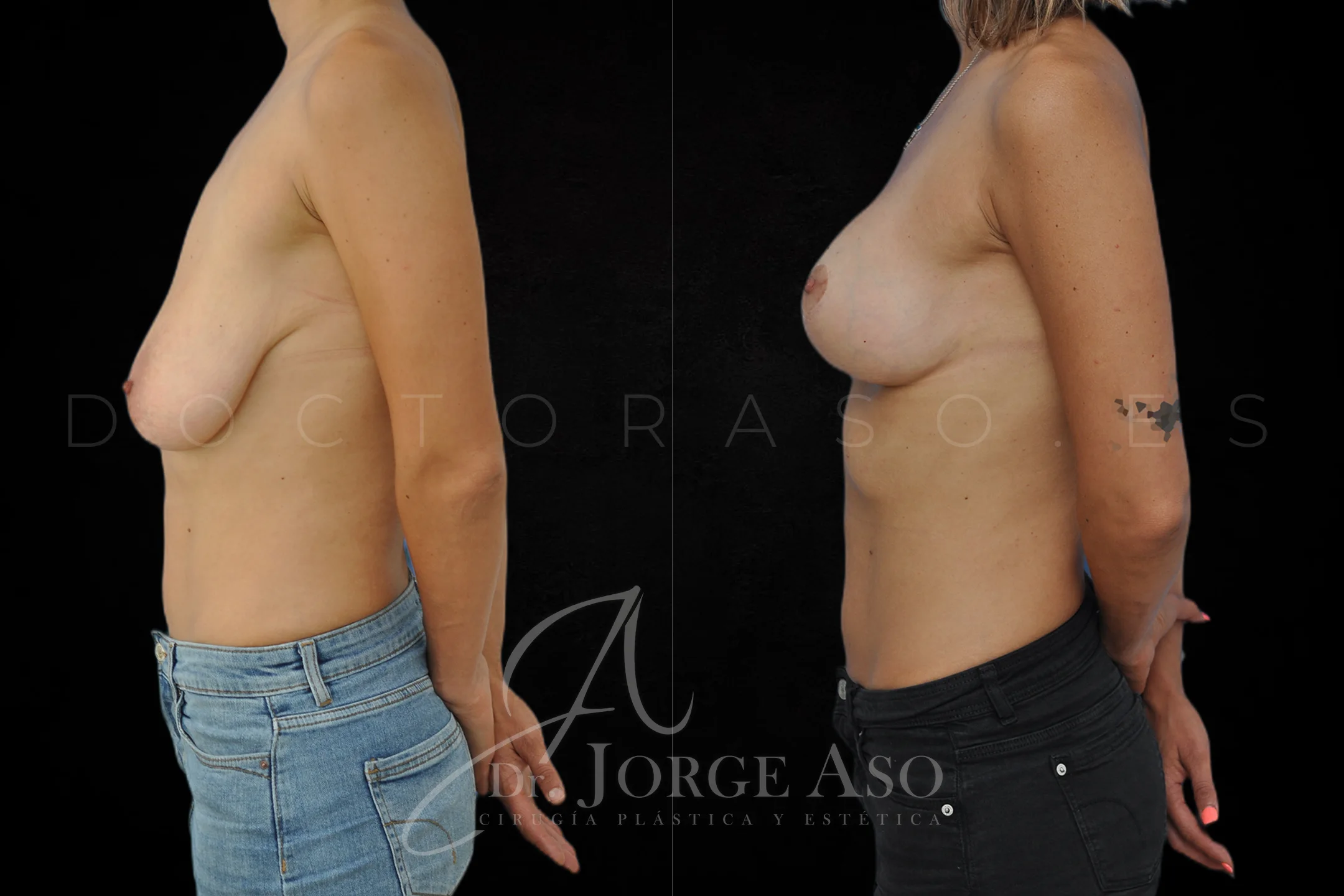 Mastopexia antes y despues con protesis Redondas de 320 cc vista lateral