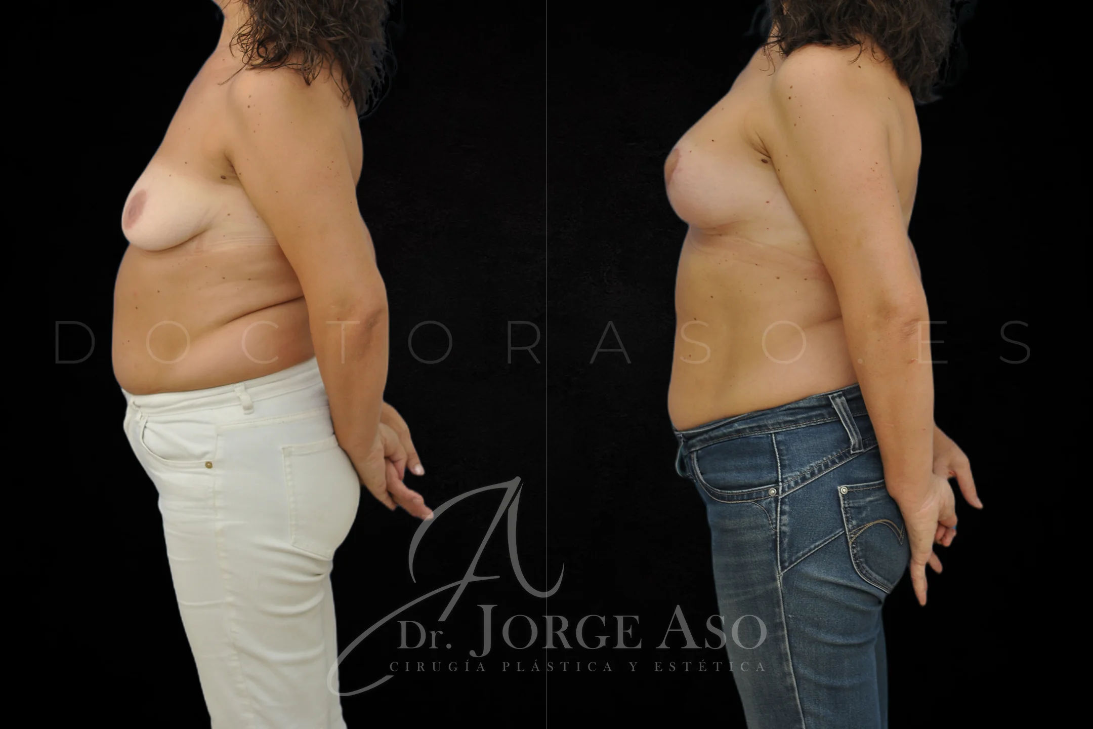 Mastopexia antes y despues con protesis Redondas de 320 cc vista lateral
