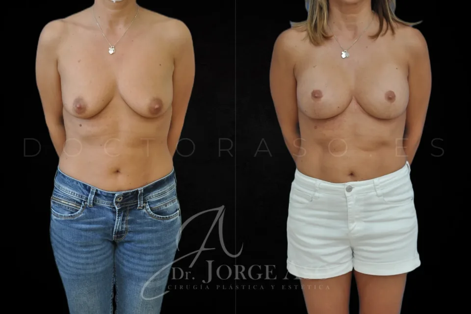 Mastopexia antes y después, prótesis redondas, 325 cc, perfil moderado, vista frontal