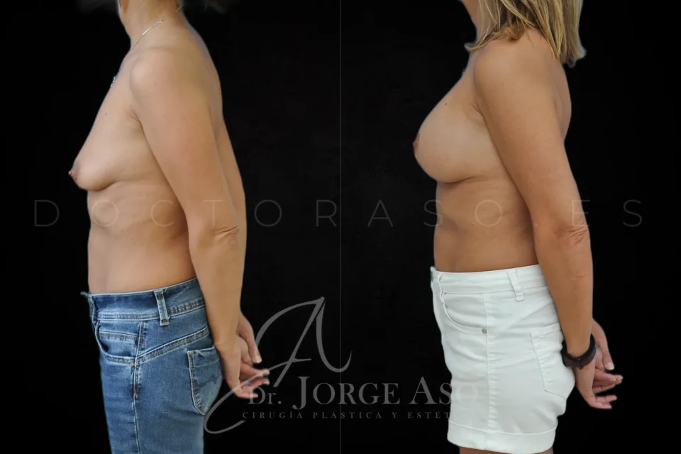 Mastopexia antes y después, prótesis redondas, 325 cc, perfil moderado, vista lateral