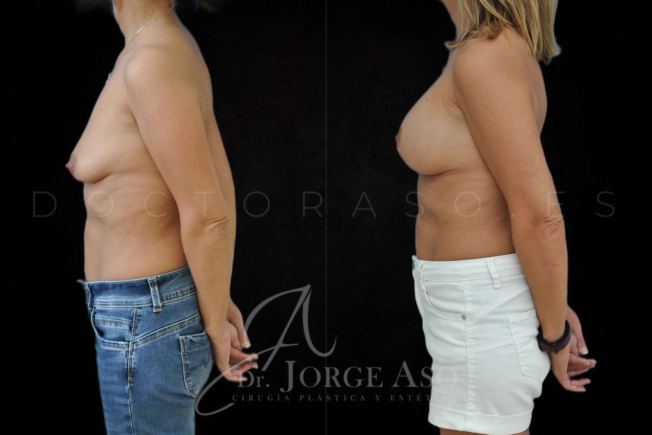 Mastopexia antes y despues con protesis Redondas de 325 cc vista lateral