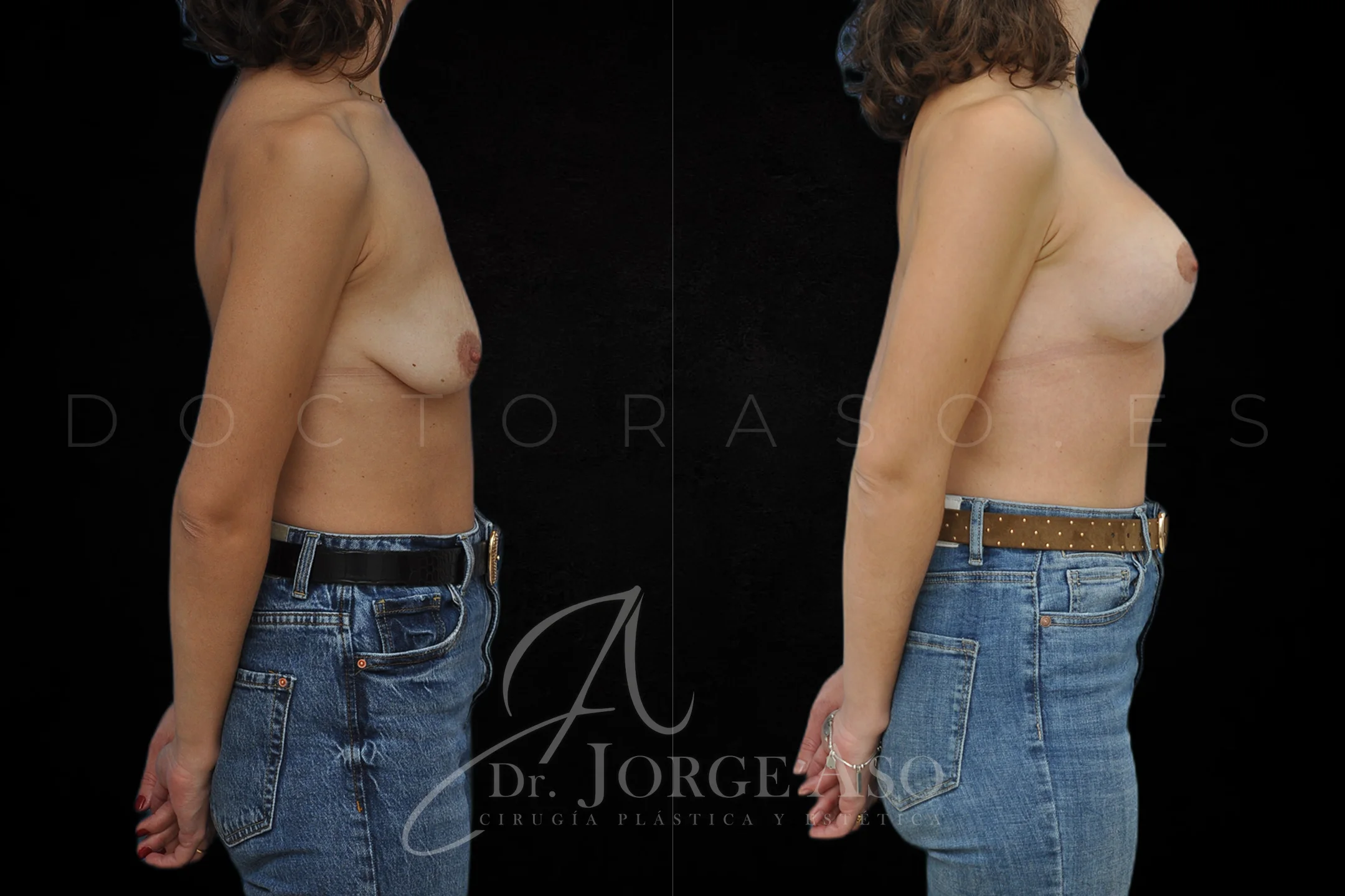 Mastopexia antes y despues con protesis Redondas de 335 cc vista lateral