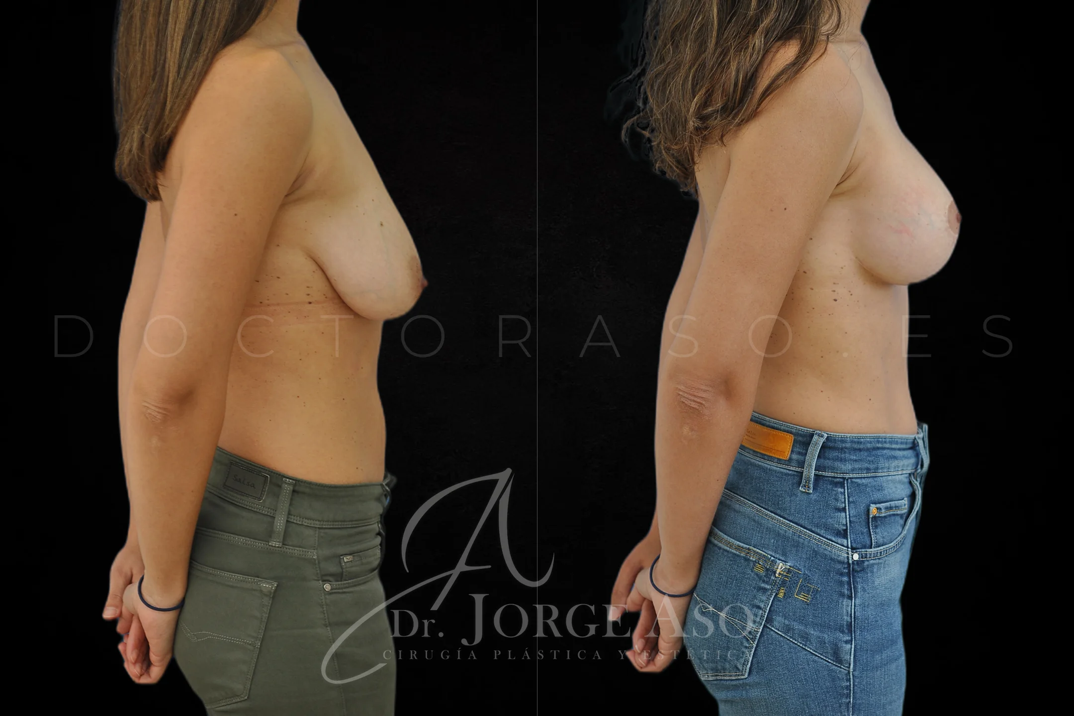 Mastopexia antes y despues con protesis Redondas de 360 cc vista lateral