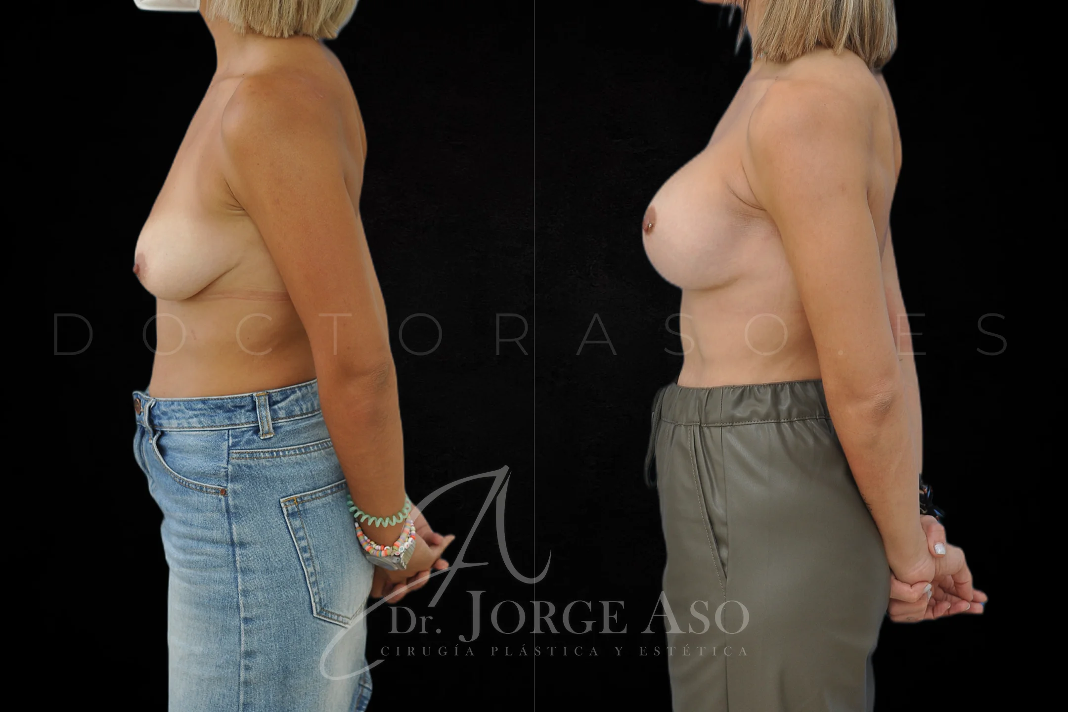 Mastopexia antes y despues con protesis Redondas de 360 cc vista lateral