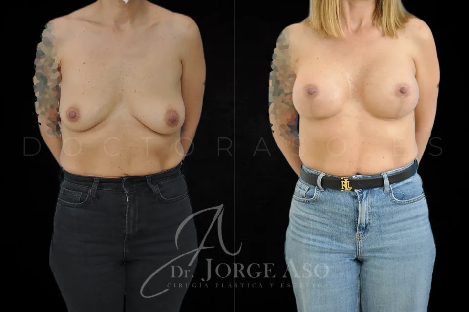 Mastopexia antes y después, prótesis redondas, 400 cc, perfil alto, vista frontal