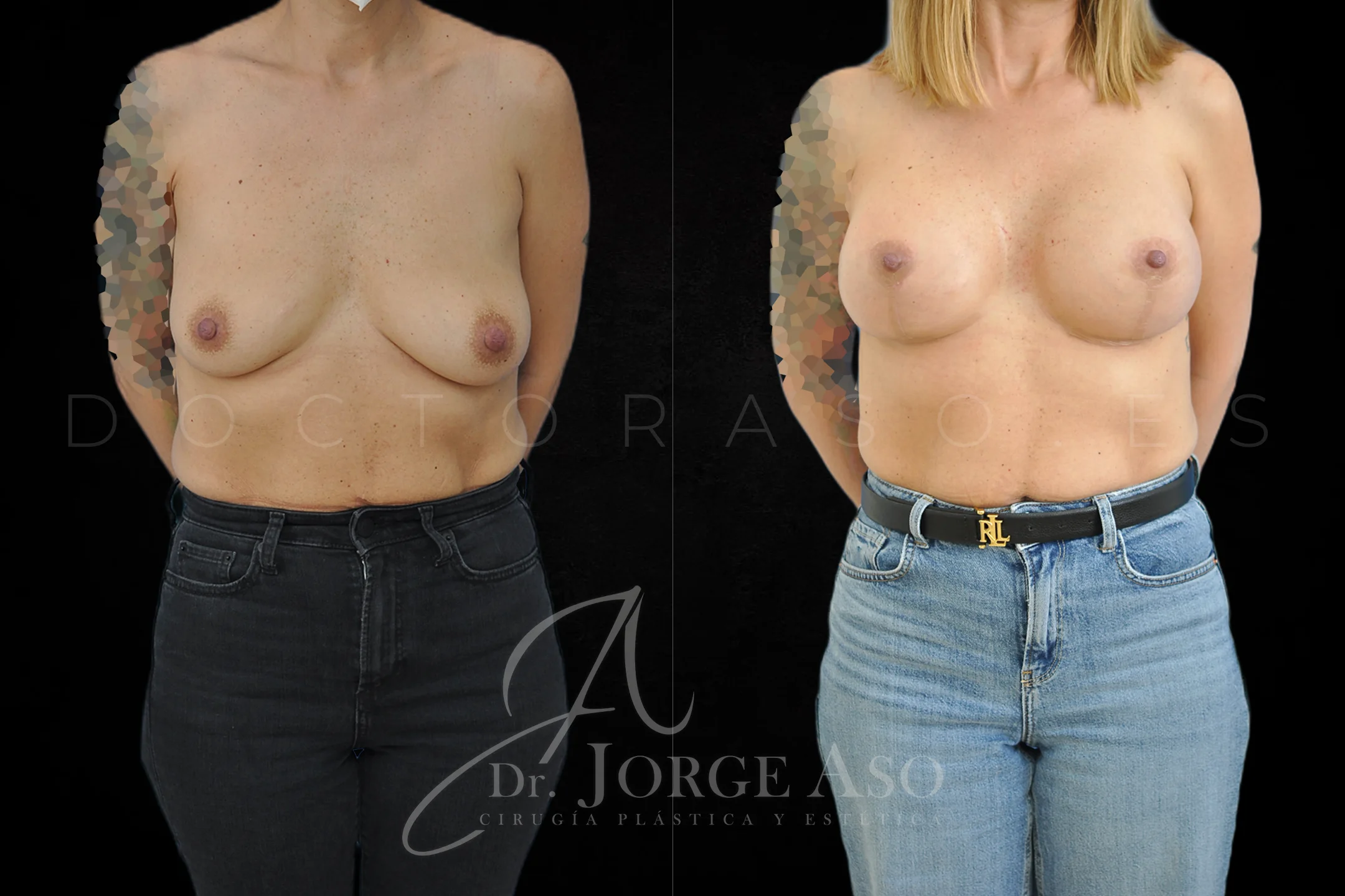 Mastopexia antes y despues con protesis Redondas de 400 cc vista frontal