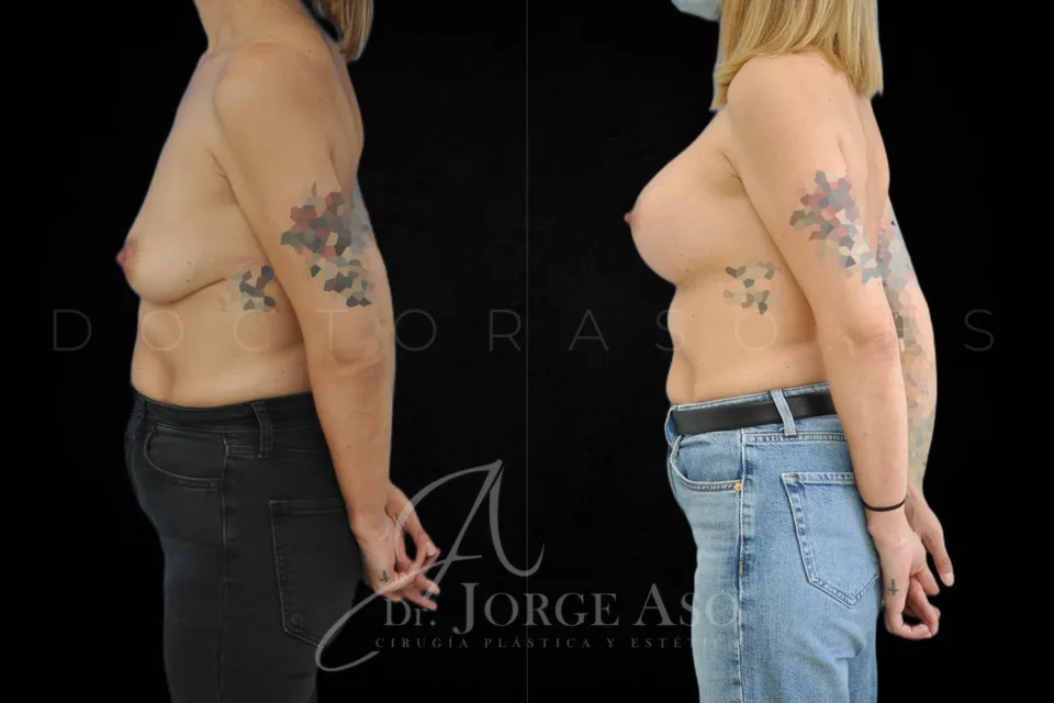 Mastopexia antes y después, prótesis redondas, 400 cc, perfil alto, vista lateral
