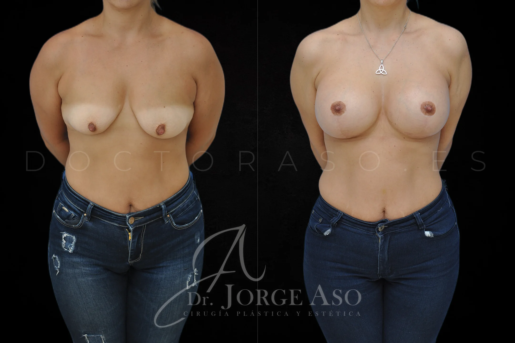 Mastopexia antes y despues con protesis Redondas de 610 cc vista frontal