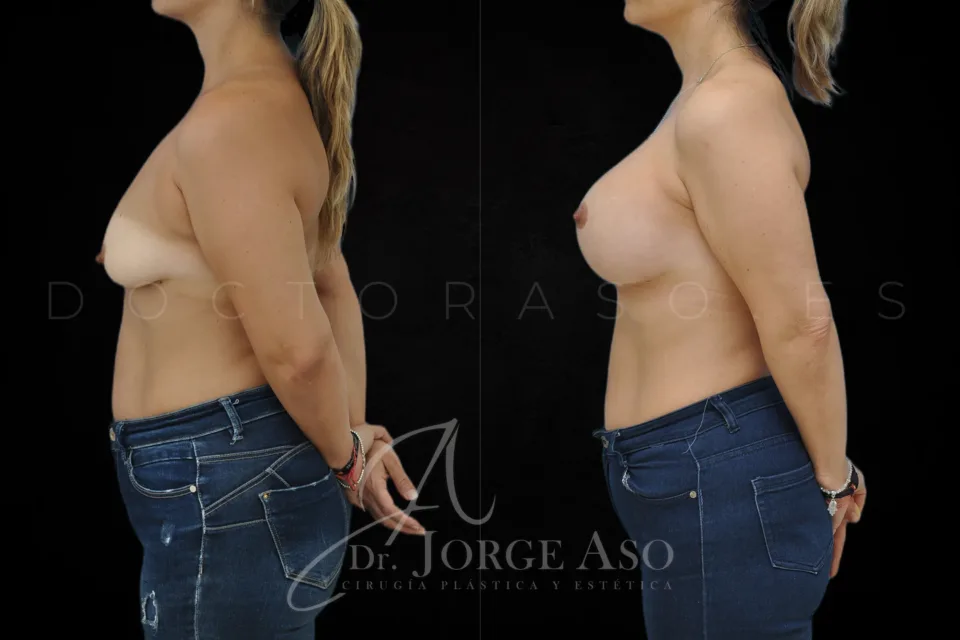 Mastopexia antes y después, prótesis redondas, 610 cc, perfil extra alto, vista lateral