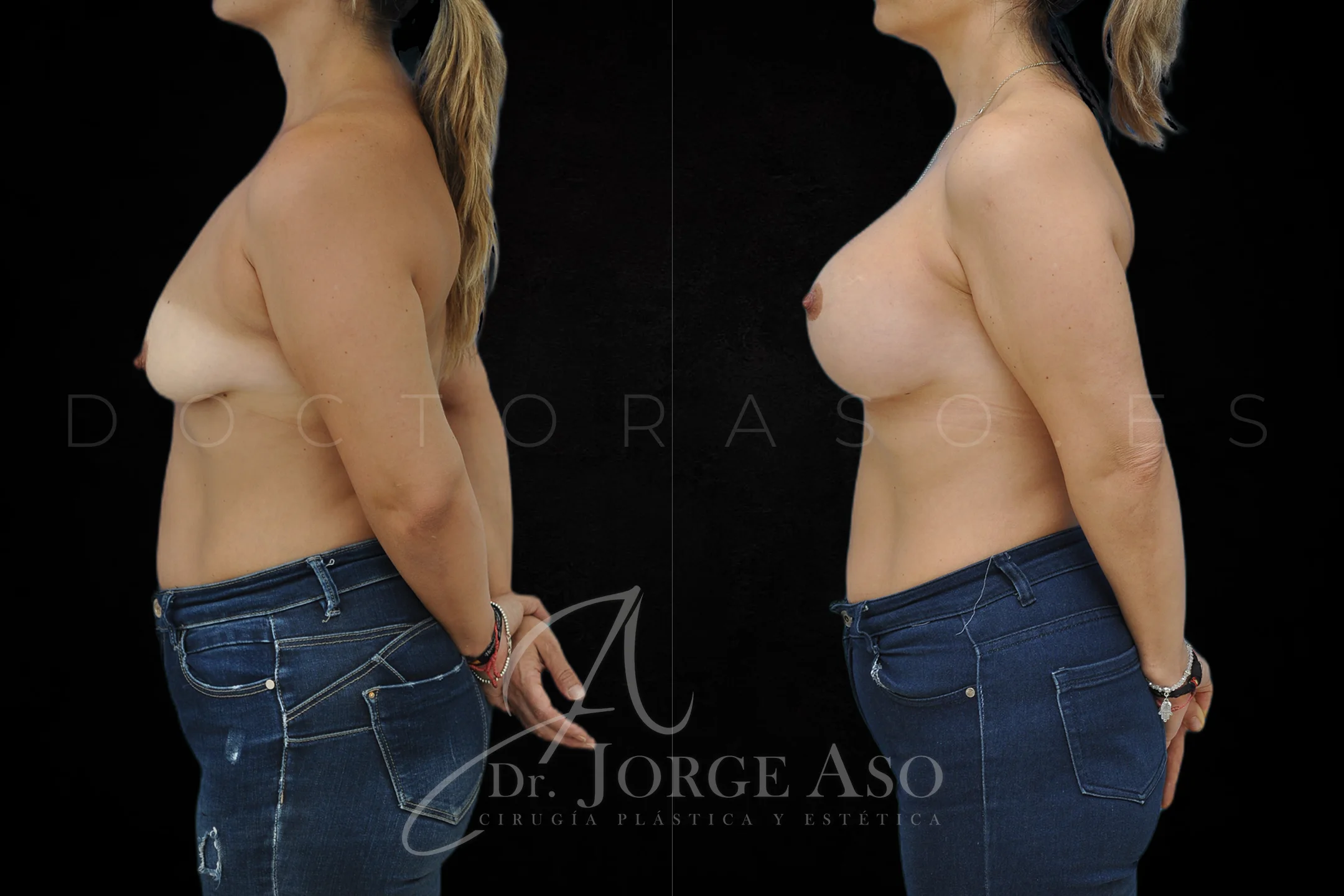 Mastopexia antes y despues con protesis Redondas de 610 cc vista lateral
