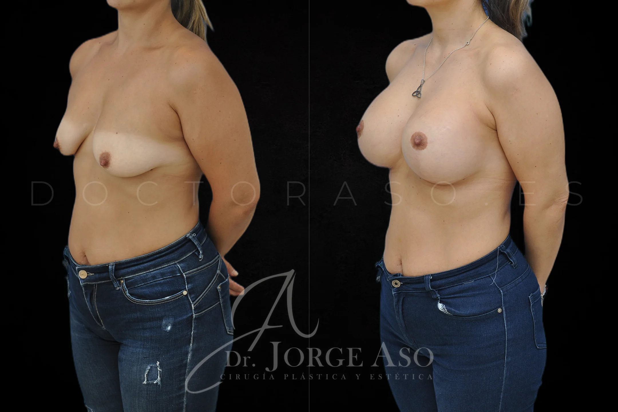 Mastopexia antes y despues con protesis Redondas de 610 cc vista oblicua
