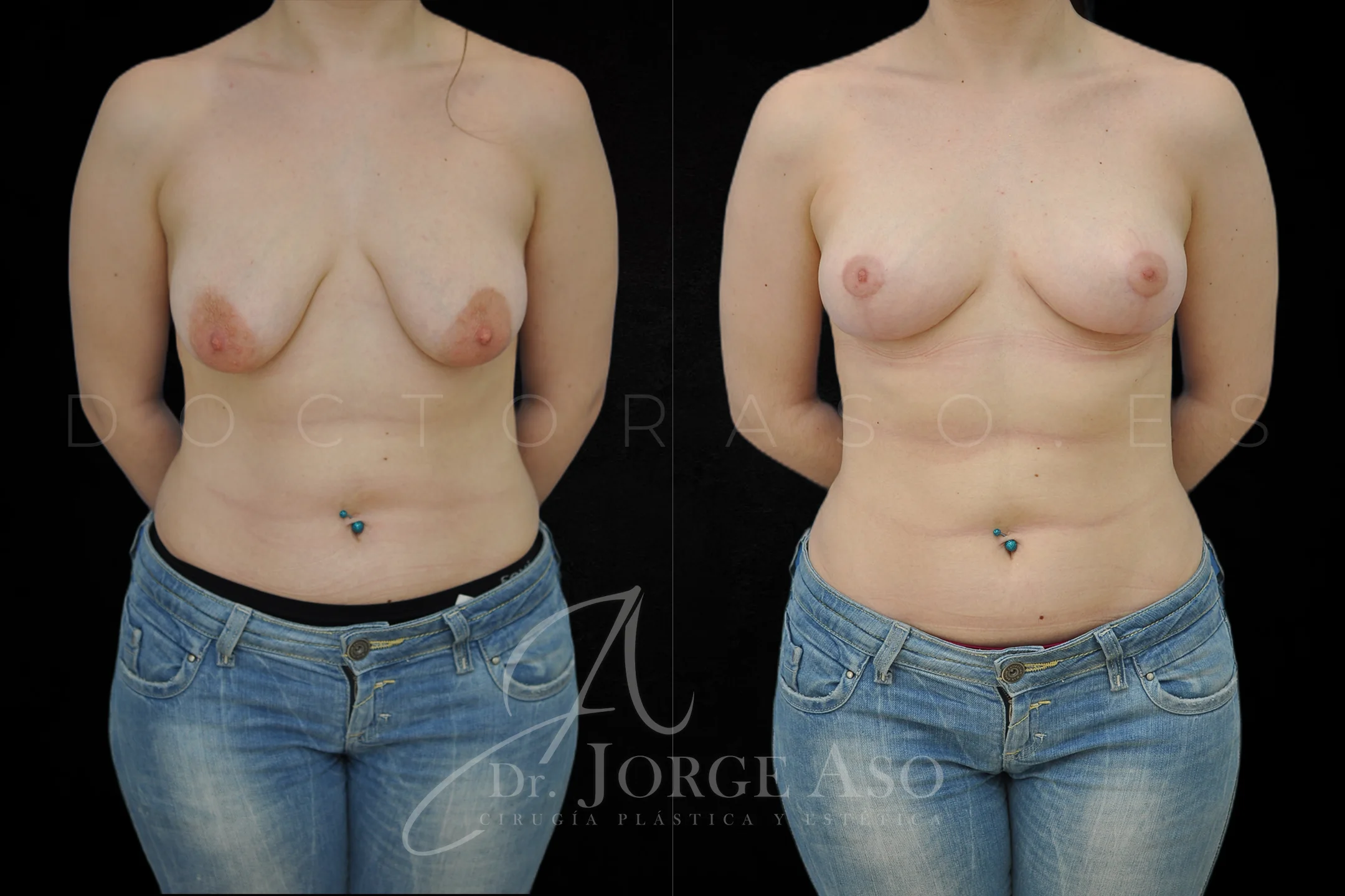 Mastopexia antes y despues sin protesis vista frontal