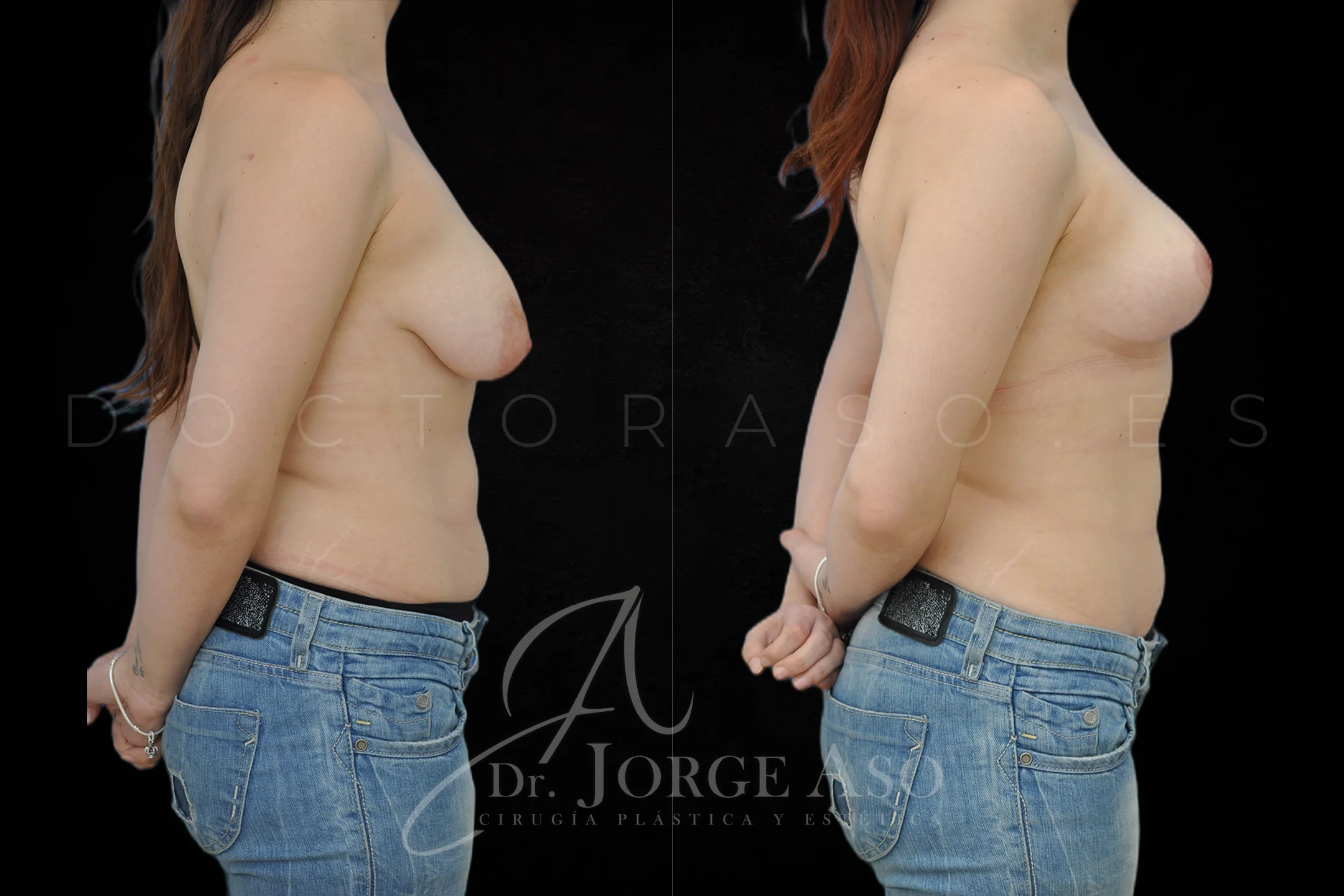 Mastopexia antes y despues sin protesis vista lateral