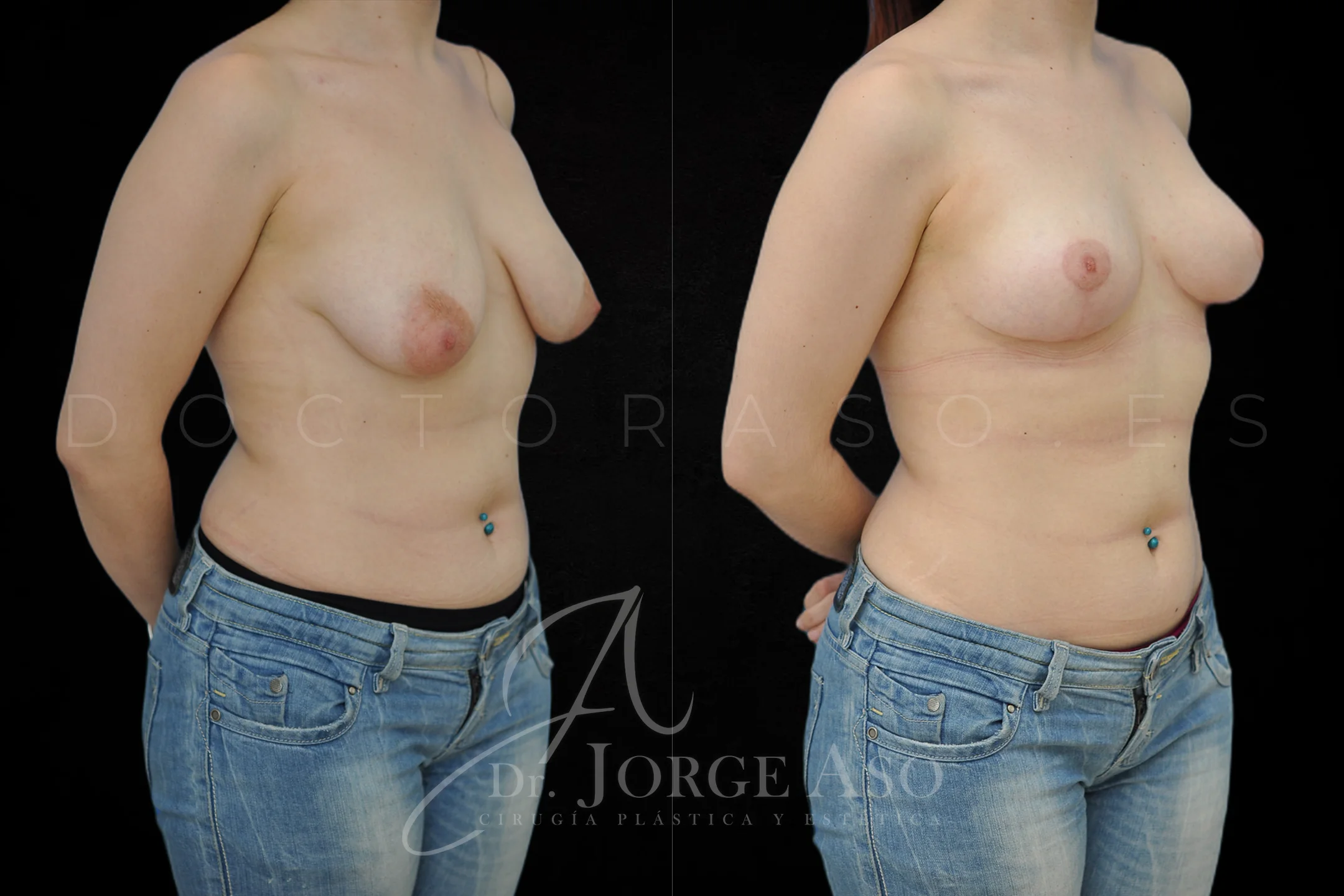 Mastopexia antes y despues sin protesis vista oblicua